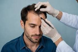 Hair Wash After Transplant: When to Start and How to Do It Safely