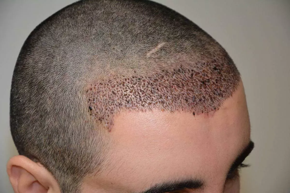 Timeline of Hair Transplant Results: What to Anticipate Each Month