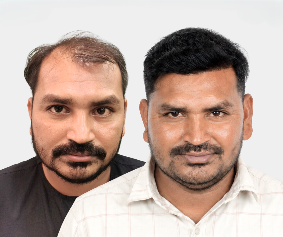 Before After Result