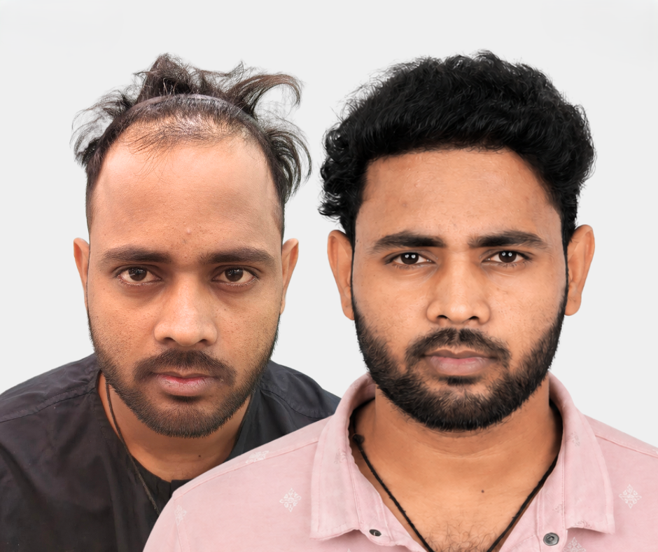 Before After Result