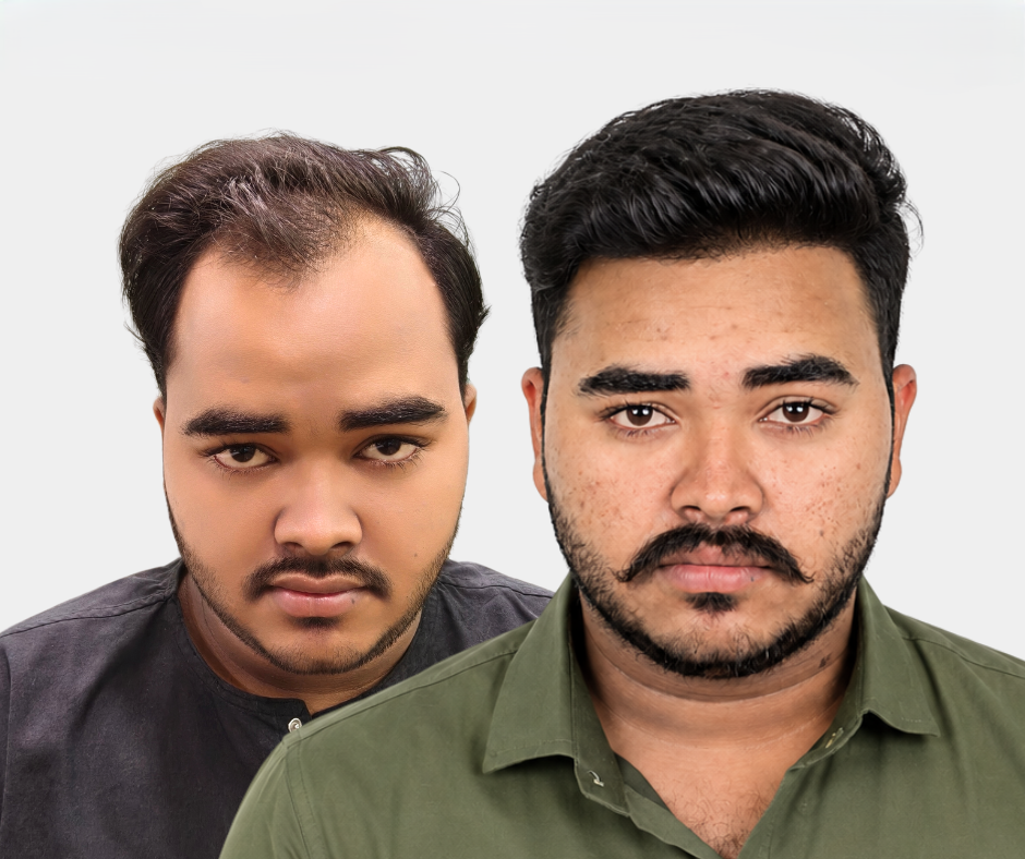 Before After Result