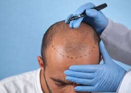 What is Bad Hair Transplant Correction?