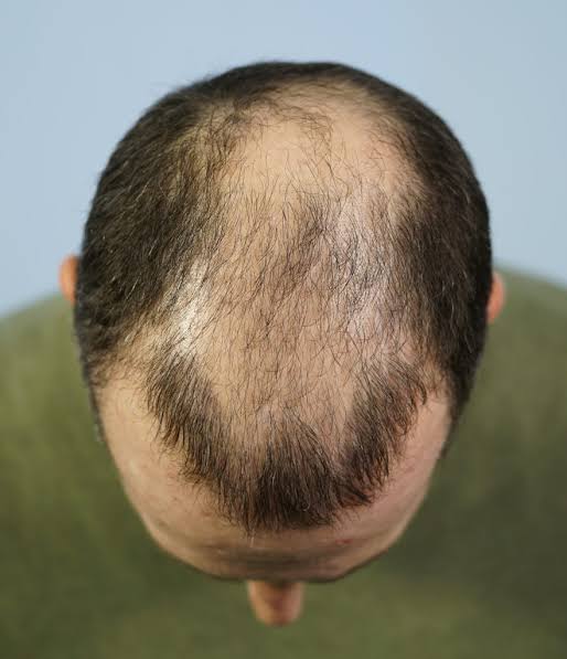Bad Hair Transplant Correction in India
