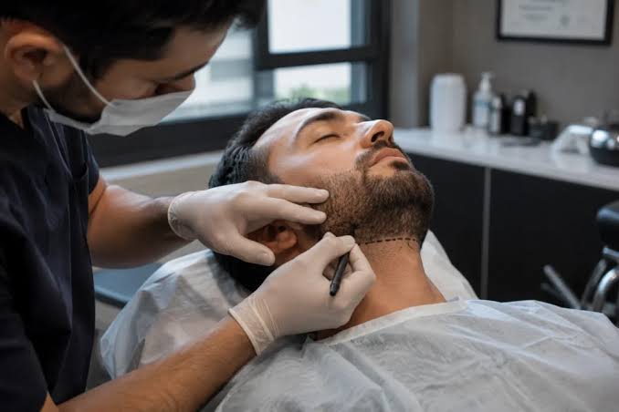 Beard Hair Transplant