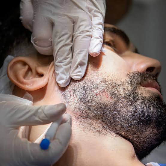 What is A Beard Hair Transplant