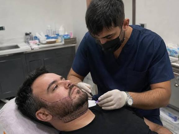 Beard Hair Transplant In India