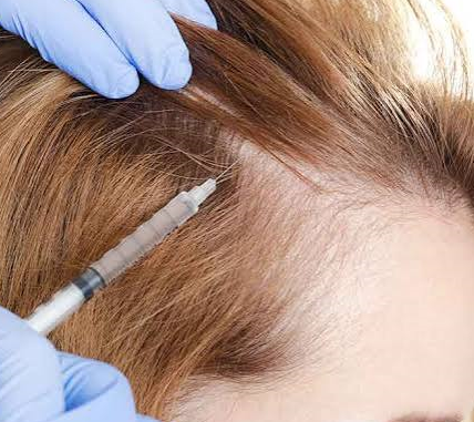 Female Hair Transplant in India?