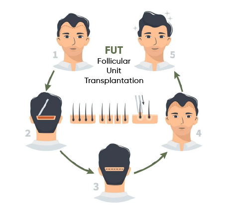 Follicular Unit Transplantation (FUT)