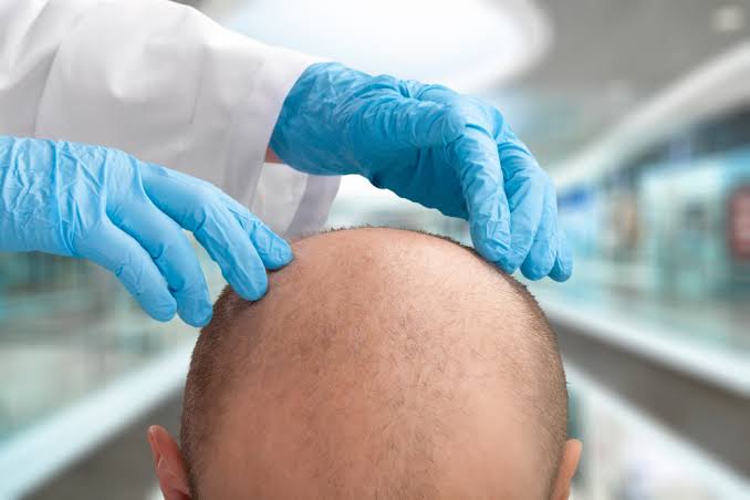 Caucasian Patients Hair Transplant