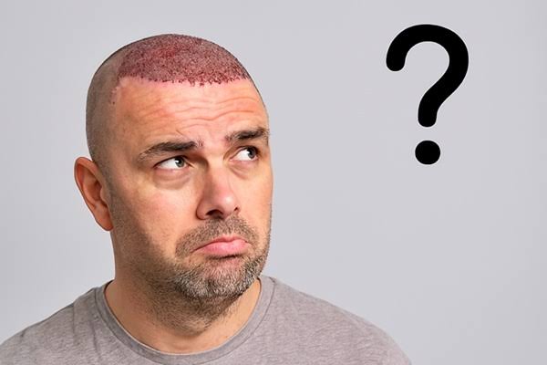 What is Hair Transplant for Caucasian Men?