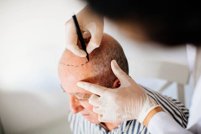 Hair Transplant for Caucasian Men in India