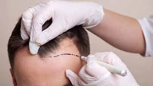 Custom Hairline Transplant India.