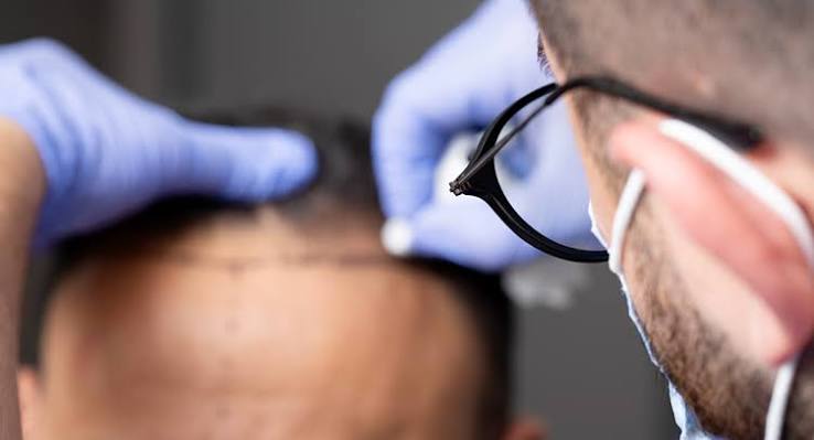 What is Hairline Reconstruction?