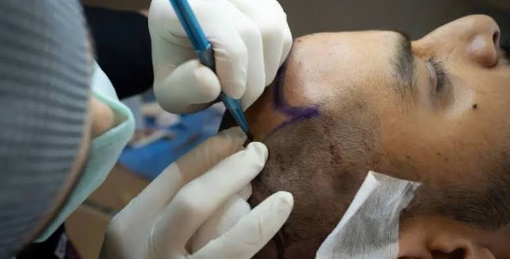 Hairline Reconstruction in India