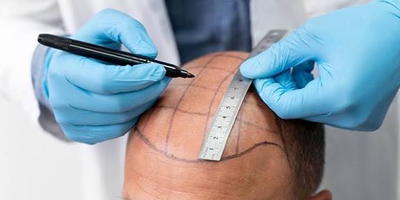 What is FUT Hair Transplant?