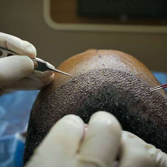 What is a Male Hair Transplant?
