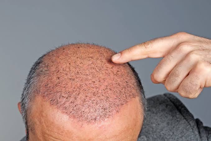 Male Hair Transplant in India