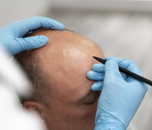 FUT Hair Transplant in India