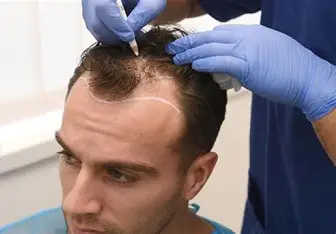What is Hair Transplant Repair?