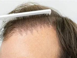 Hair Transplant Repair in India