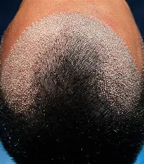 What is a No-Shave Hair Transplant?