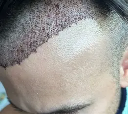 Unshaven Hair Transplant in India