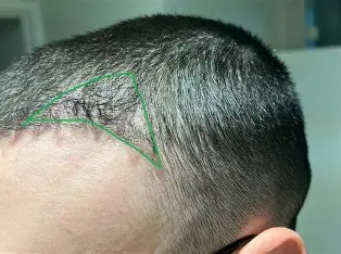 Ultra Dense Hair Transplant in India