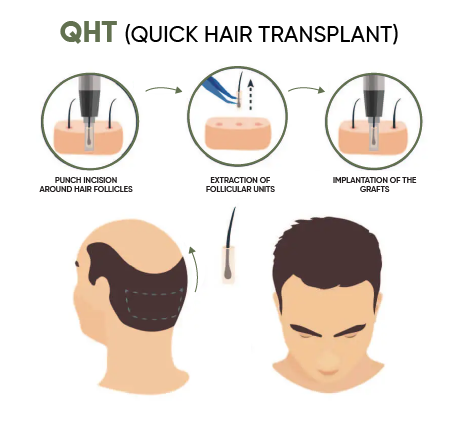AGE Hair Transplant
