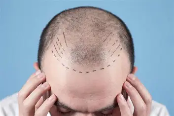 What is FUE Hair Transplant?