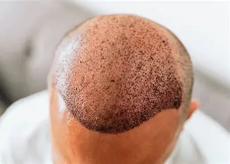 FUE Hair Transplant in India