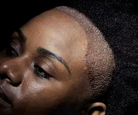 Affordable Afro Hair Transplant India