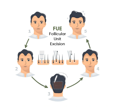 Follicular Unit Excision (FUE)