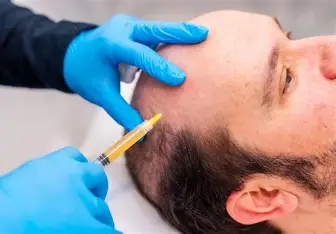 What is Burn Hair Transplant?