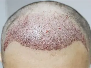 Burn Hair Transplant in India