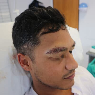 Eyebrow Reconstruction in India