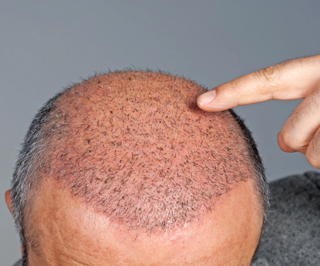 What is Natural Look Hair Restoration?