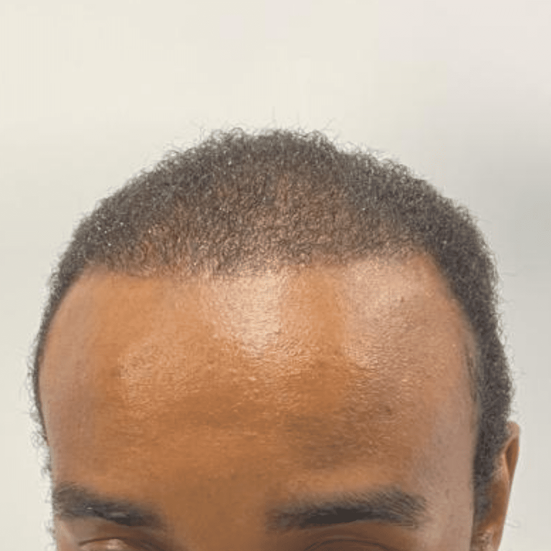 Natural Hair Transplant in India