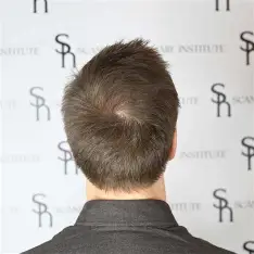 What is Temple Hair Transplant?