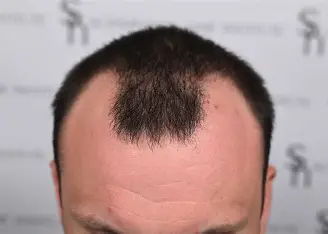 Temple Hair Transplant Cost in India