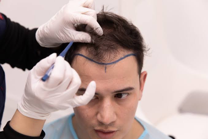 Burn Hair Transplant