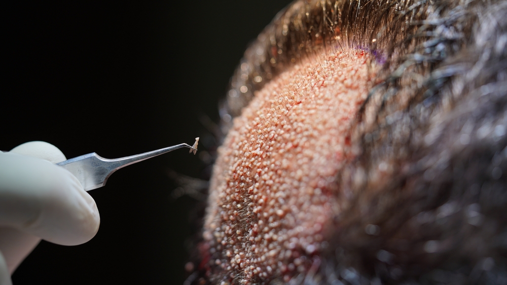 Unshaven Hair Transplant 
