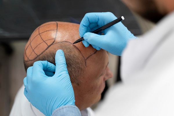 FUT Hair Transplant