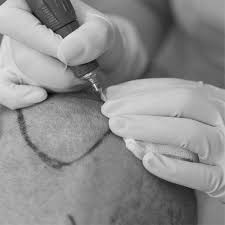 WHAT IS QHT HAIR TRANSPLANT?