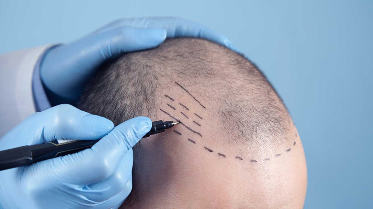 Custom Hairline Transplant