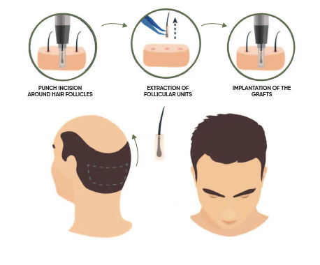 AGE hairline transplant